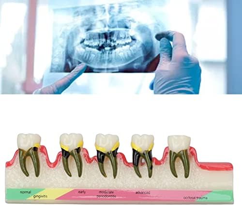 TeethDiseaseModel, Oktatási DentalPathologicalModel EnglishWords a DentalColleges
