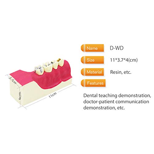 D-WD Fogászati Fogak Modell,Átlátszó Fogászati Implantátum Fogak Modell Fogorvos Standard Betegség Cserélhető Fogat Kóros Oktatási